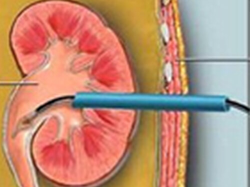 Percutaneous Nephrolithotomy (Pcnl) & Mini-Pcnl