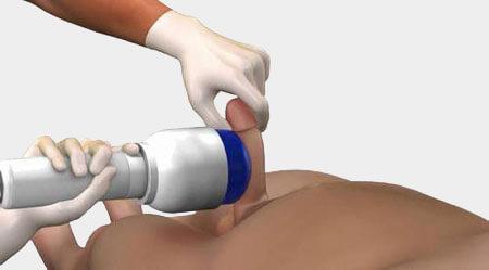 Erectile Dysfunction Shock Wave Therapy (EDSWT)